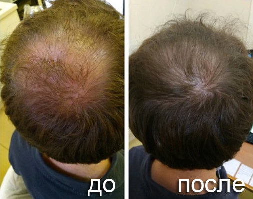 ПФО-коррекция волос